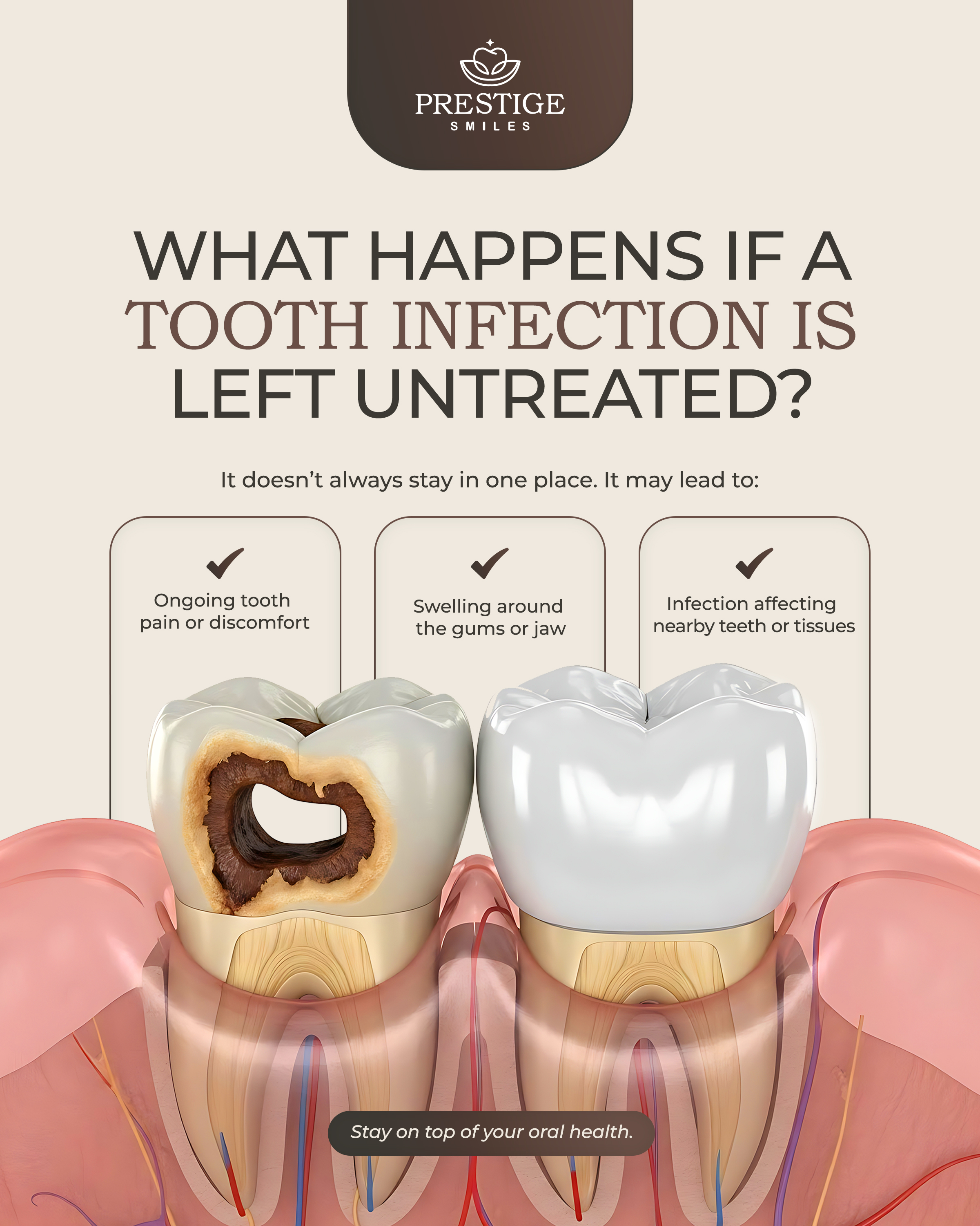 What Happens If A Tooth Infection Is Left Untreated?